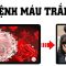 Bệnh máu trắng là gì? Hiểu rõ trong 5 phút