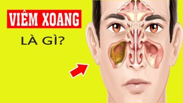 bệnh viêm Xoang là gì? Hiểu rõ chỉ trong 5 phút