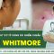 Bệnh whitmore tăng cao sau lũ lụt,  cảnh giác nguy cơ tử vong do nhiễm khuẩn | SKĐS