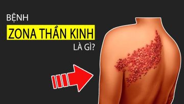 Bệnh Zona thần kinh là gì? Hiểu rõ chỉ với 5 phút
