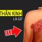 Bệnh Zona thần kinh là gì? Hiểu rõ chỉ với 5 phút