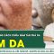 Cảnh Báo Những Cách Chữa Nám Tàn Phá Da | SKĐS