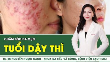 Chăm sóc da mụn tuổi dậy thì | SKĐS