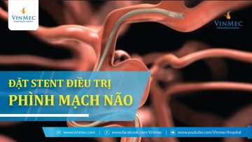 Đặt Stent chuyển hướng dòng chảy điều trị phình mạch não