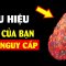 ĐỪNG CHỦ QUAN: 10 dấu hiệu cho thấy bạn bị suy thận