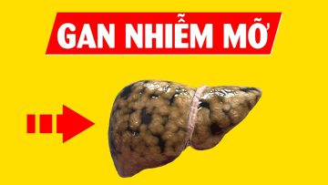 Gan nhiễm mỡ là gì? Giải thích cực dễ hiểu trong 5 phút