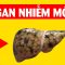 Gan nhiễm mỡ là gì? Giải thích cực dễ hiểu trong 5 phút