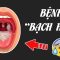 Hiểu rõ về bệnh Bạch hầu trong 5 phút