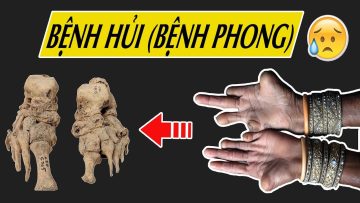 Hiểu về bệnh Phong chỉ trong 5 phút 😢