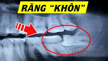 Răng khôn – Răng số 8 có gì đặc biệt? Hiểu rõ trong 5 phút
