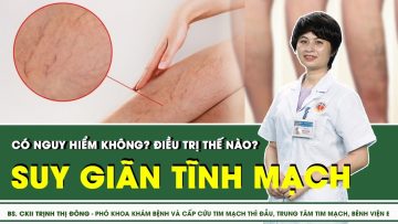 Suy giãn tĩnh mạch điều trị thế nào? | SKĐS