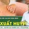 Từng mắc sốt xuất huyết, có cần tiêm vaccine phòng bệnh? | SKĐS