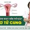 U xơ tử cung biến chứng nguy hiểm thế nào? | SKĐS