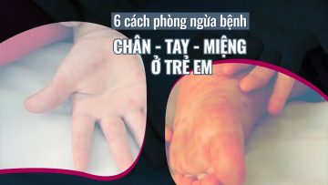 6 bí kíp giúp các bậc phụ huynh phòng ngừa bệnh chân – tay – miệng ở con trẻ | VTC Now