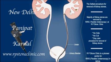 Animation of Kidney stone treatment by RIRS  Flexible Ureteroscopy