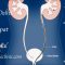 Animation of Kidney stone treatment by RIRS  Flexible Ureteroscopy