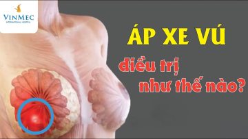 Áp xe vú điều trị như thế nào?