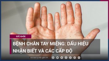 Bệnh chân tay miệng ở trẻ: Dấu hiệu nhận biết và các cấp độ | VTC Now