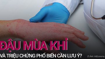 Bệnh đậu mùa khỉ: Bao phủ hơn 20 nước, cần lưu ý gì về triệu chứng phổ biến? | VTC Now