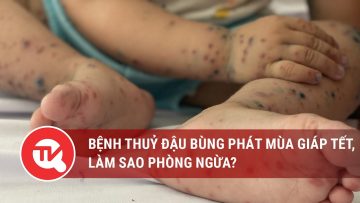 Bệnh Thuỷ đậu bùng phát mùa giáp Tết, làm sao phòng ngừa? | Truyền hình Quốc hội Việt Nam