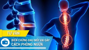 Biến chứng đau mỏi vai gáy và cách phòng ngừa