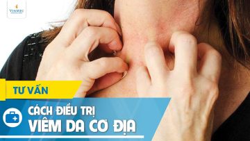 Cách điều trị viêm da cơ địa