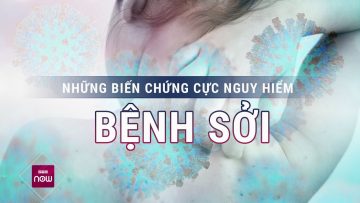 Cảnh báo: Những biến chứng cực kỳ nguy hiểm của bệnh sởi | VTC Now