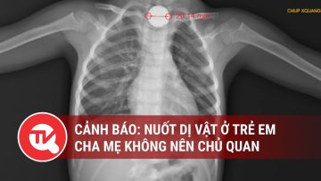 Cảnh báo: Nuốt dị vật ở trẻ em, cha mẹ không nên chủ quan | Truyền hình Quốc hội Việt Nam