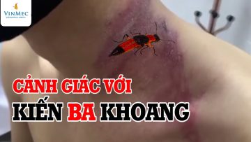 Cảnh giác với kiến ba khoang| BS Nguyễn Thanh Vân BV Vinmec Phú Quốc