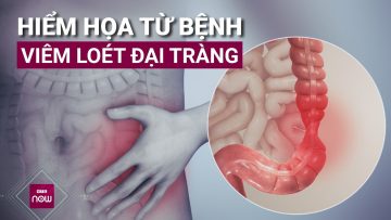 Hiểm hoạ từ bệnh viêm loét đại tràng: Tuyệt đối không được chủ quan | VTC Now