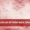 Làm sao để phòng ngừa zona thần kinh? | Truyền hình Quốc hội Việt Nam