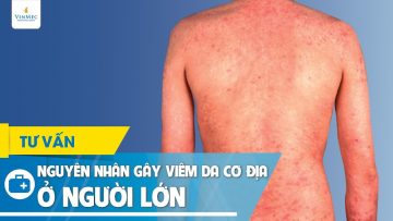 Nguyên nhân gây viêm da cơ địa ở người lớn