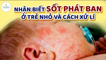 Nhận biết sốt phát ban ở trẻ nhỏ và cách xử lý