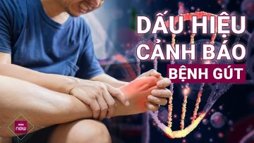 Những dấu hiệu rõ ràng cảnh báo bệnh gút nhưng rất dễ bị bạn bỏ qua | VTC Now