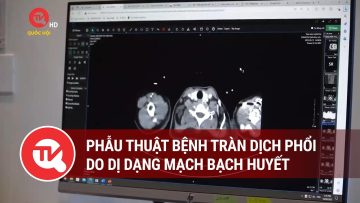 Phẫu thuật bệnh tràn dịch phổi do dị dạng mạch bạch huyết