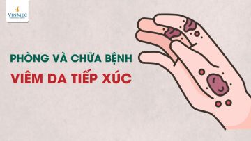 Phòng và chữa bệnh viêm da tiếp xúc