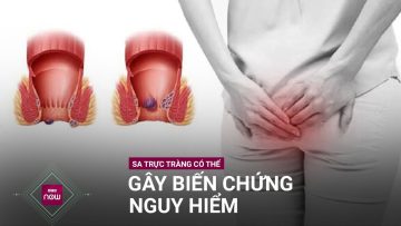 Sa trực tràng: Đừng chủ quan vì bệnh có thể gây biến chứng nguy hiểm | VTC Now