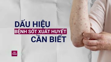 Thấy dấu hiệu lạ này bạn nên cẩn trọng và có thể nghĩ ngay đến sốt xuất huyết | VTC Now