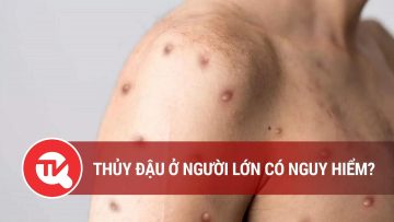 Thủy đậu ở người lớn có nguy hiểm? | Truyền hình Quốc hội Việt Nam